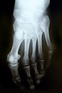 turf toe injury